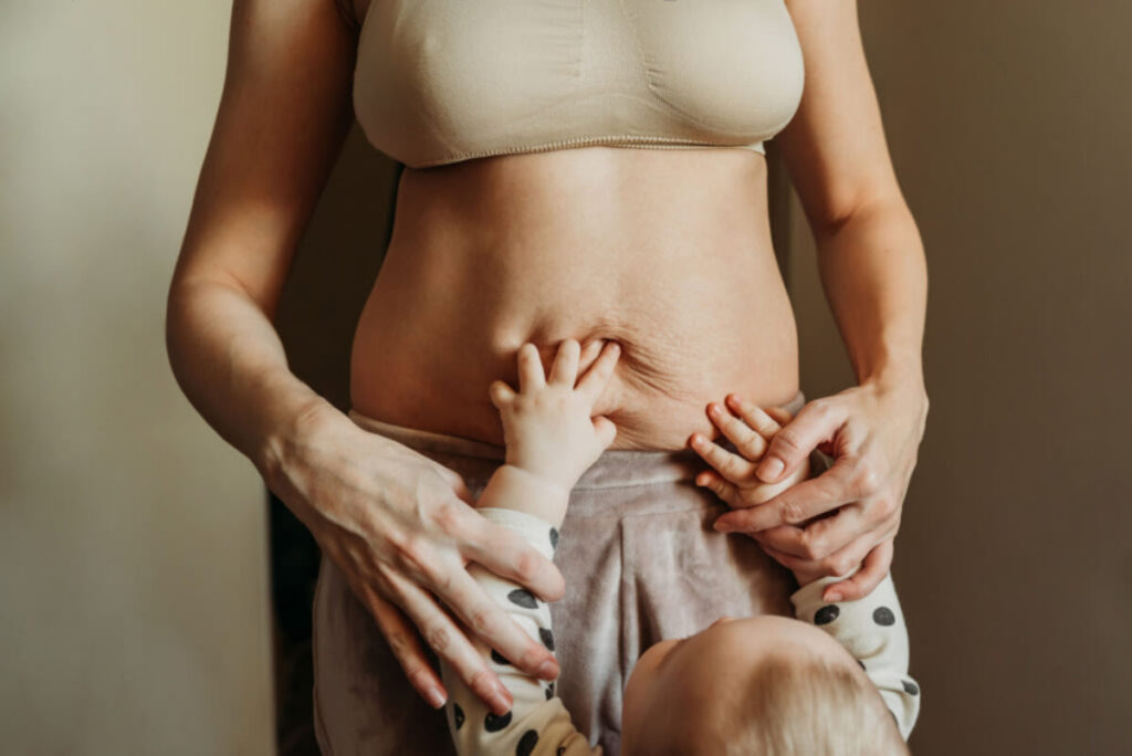diastasis recti 1200x802